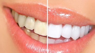 দাঁতের হলদে ভাব দূর করার উপায়