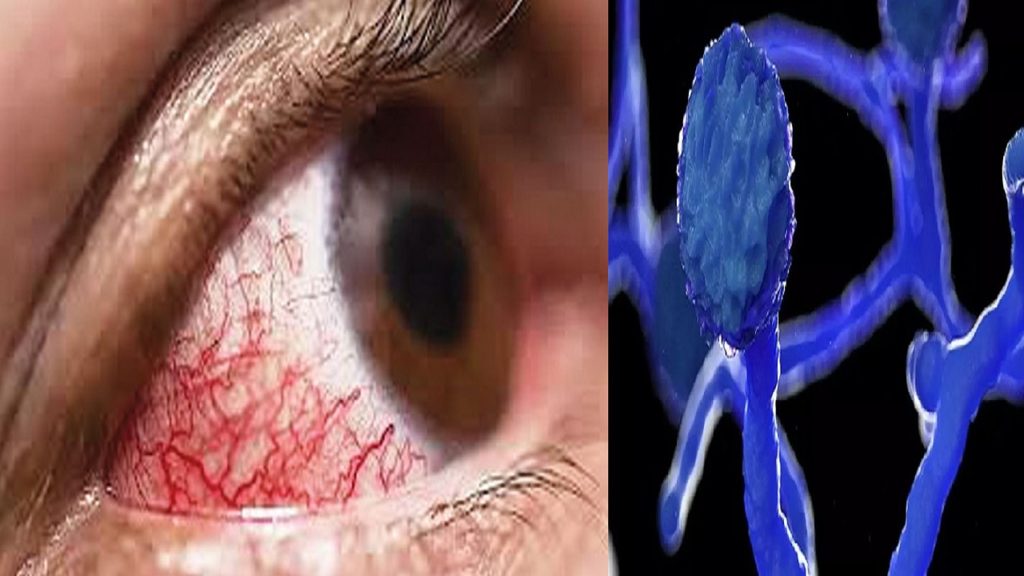 ভারতে ব্ল্যাক ফাঙ্গাস: তিন সপ্তাহে সংক্রমণ বেড়েছে দেড়'শ শতাংশ